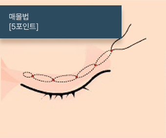 매몰법