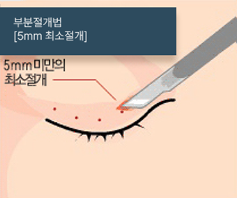 부분절개법
