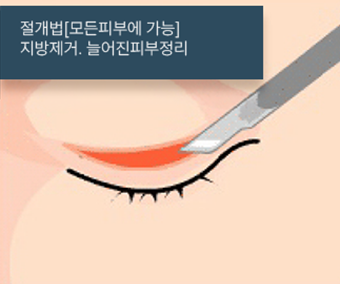 절개법