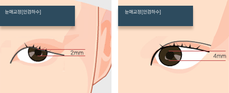 눈매교정_안검하수