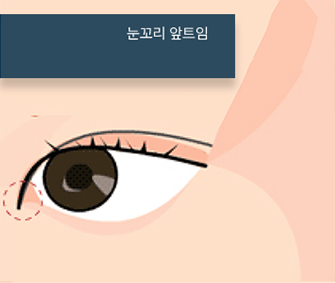 앞트임